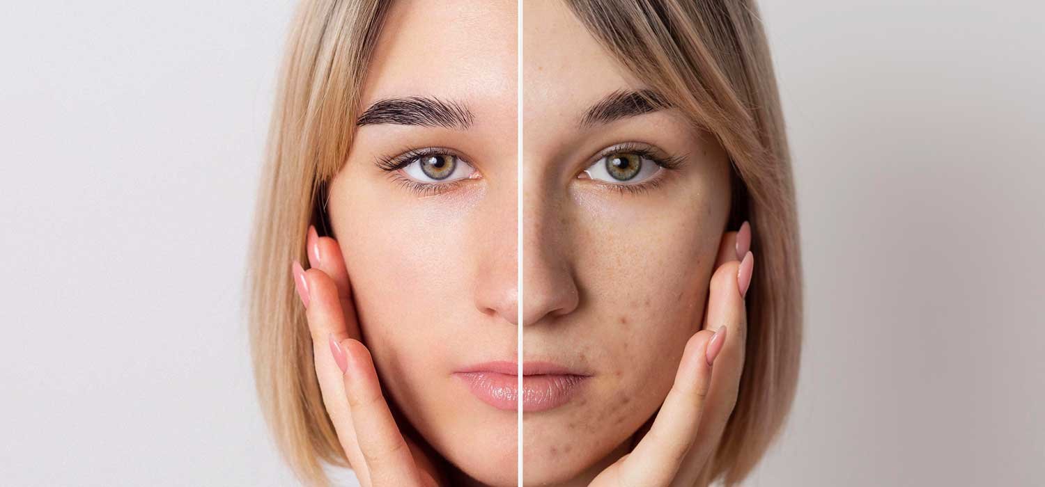 Whitening-therapy-in-kollam